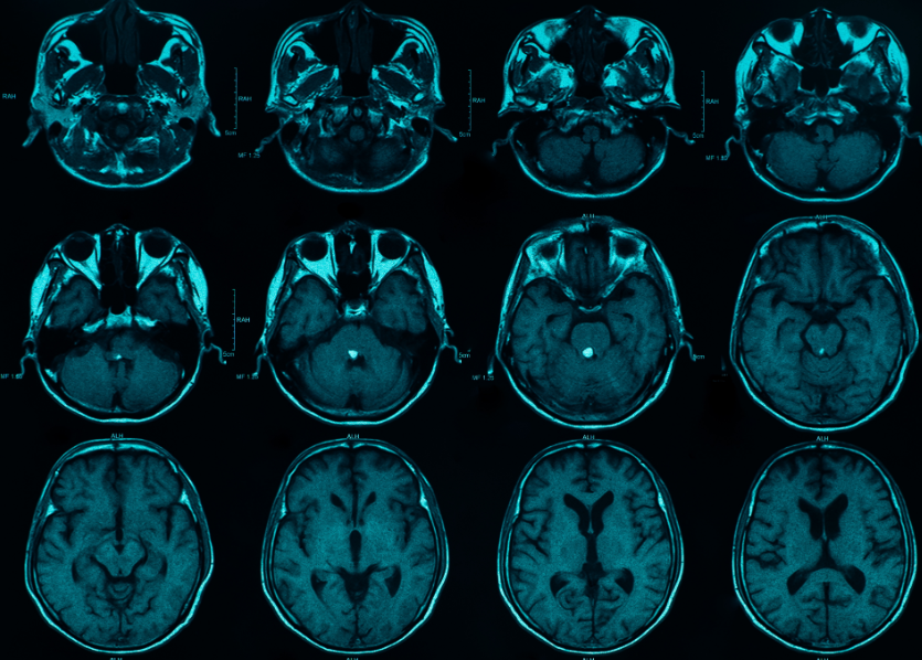 Co-located Cell Types Help Drive Aggressive Brain Tumors