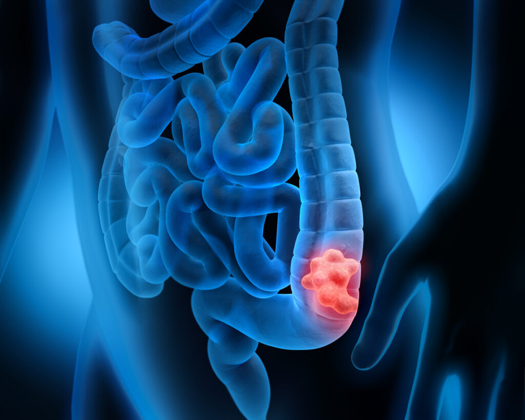 Scientists Identify Epigenetic Key That ‘Opens’ Door to Colon Cancer
