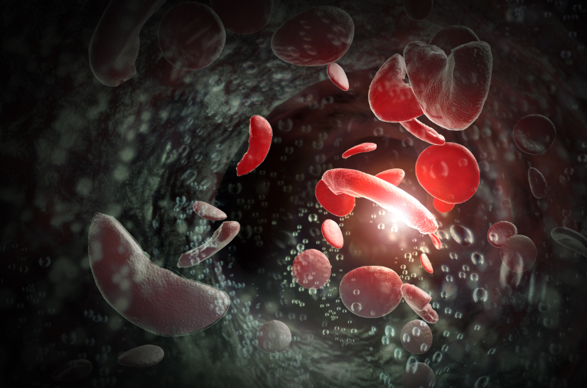 Novel Bone Marrow Transplant Can Cure Sickle Cell Disease