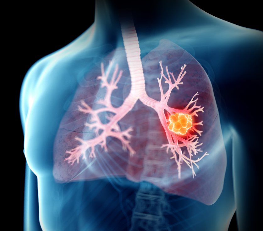 Five-Year Analysis Shows Immunotherapy Plus Chemotherapy Before Lung Cancer Surgery Significantly Improves Long-Term Survival